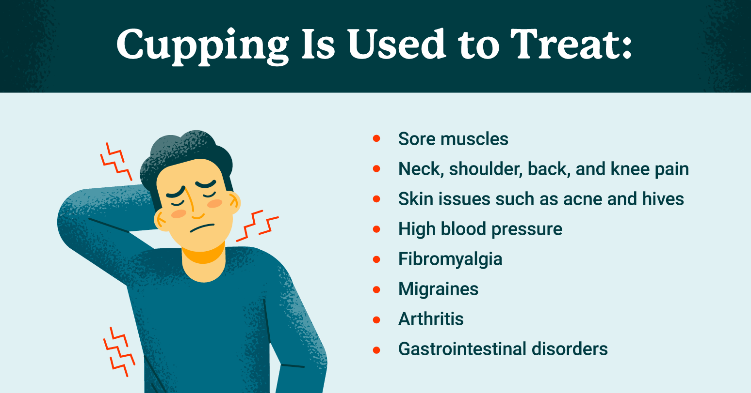 cupping therapy
