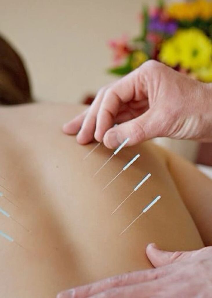 Dry Needling