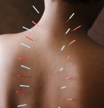 Dry needling