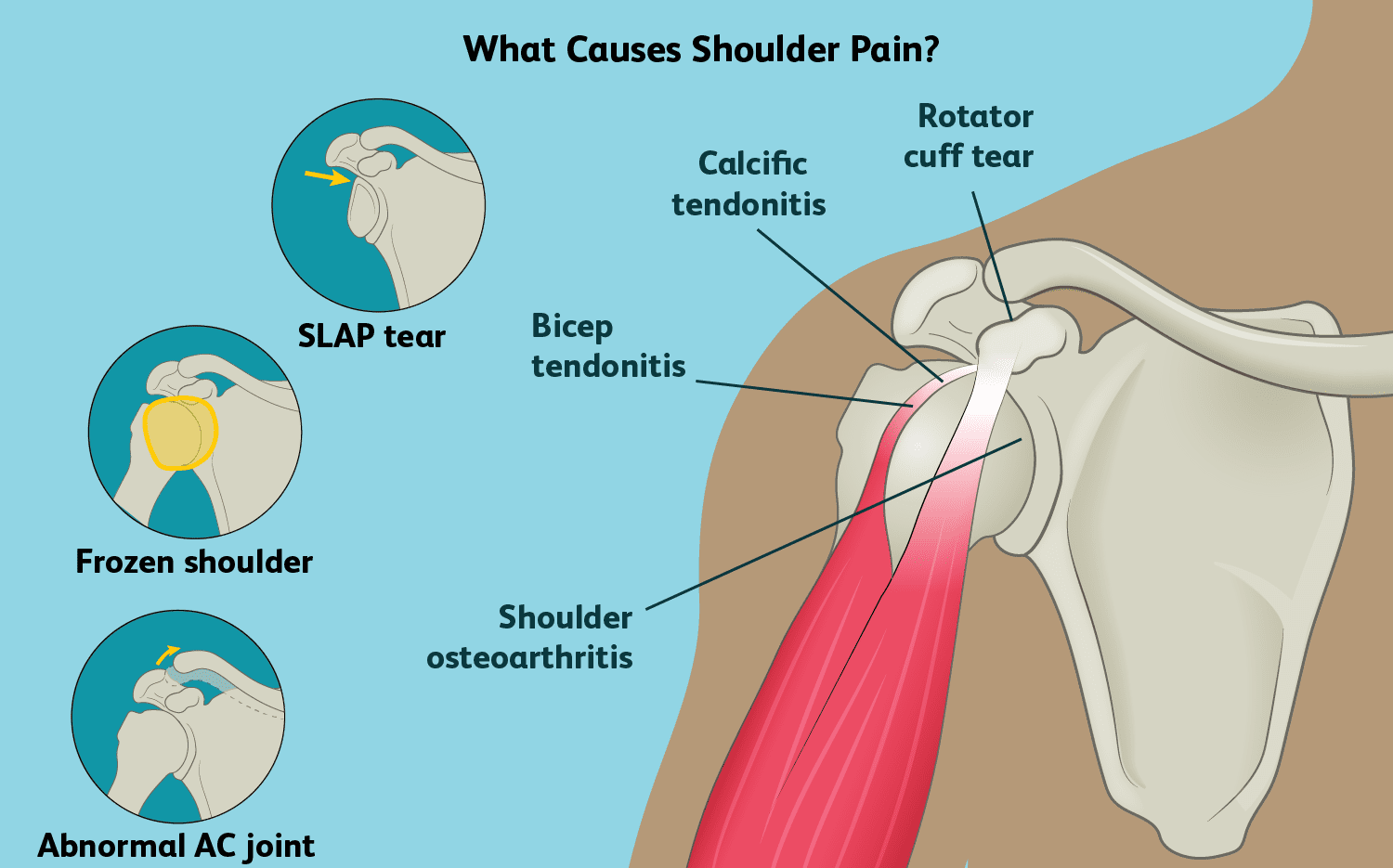 shoulder pain